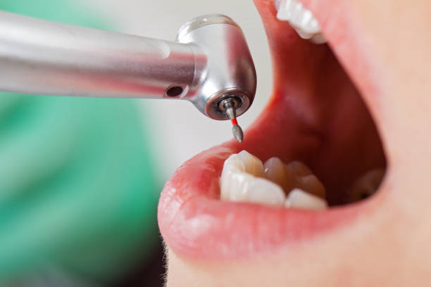 Best Chipped Tooth Repair Near Me  in Citrus City, TX